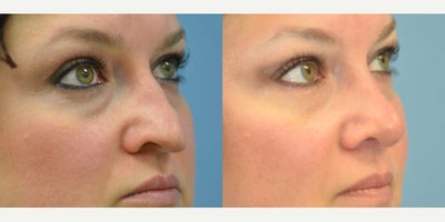 Rhinoplasty before and after photo