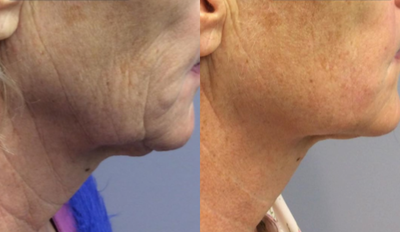 Skin Tightening before and after photo