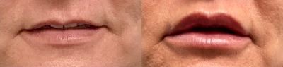 Dermal Fillers before and after photo