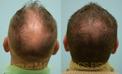 Hair Loss Treatment before and after photo