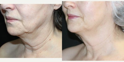 before and after image