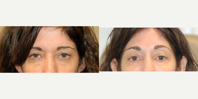 Eyelid Surgery before and after photo