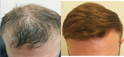 FUE Hair Transplant before and after photo