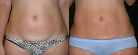 Liposuction before and after photo