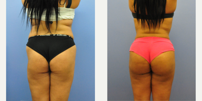 Brazilian Butt Lift before and after photo