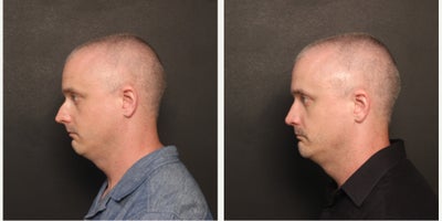 Chin Implant before and after photo