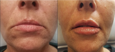 Dermal Fillers before and after photo
