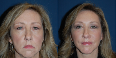 Eyelid Surgery before and after photo