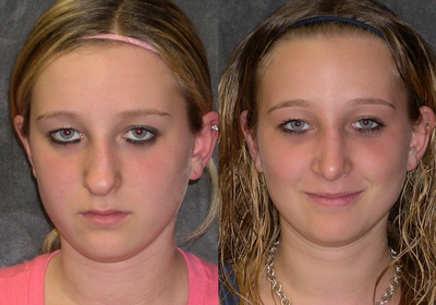 Rhinoplasty before and after photo