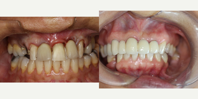 Tooth Repair before and after photo