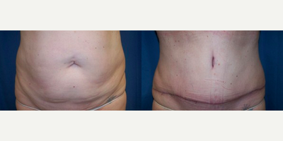 Tummy Tuck before and after photo