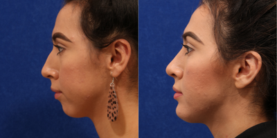 Buccal Fat Removal before and after photo