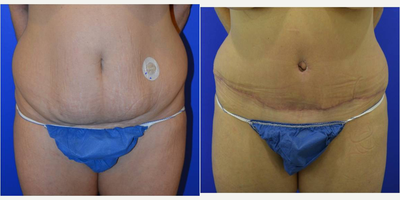 Tummy Tuck before and after photo