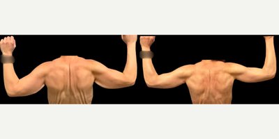 Arm Lift before and after photo