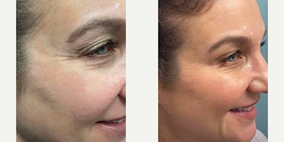 Botox before and after photo