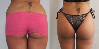 Brazilian Butt Lift before and after photo