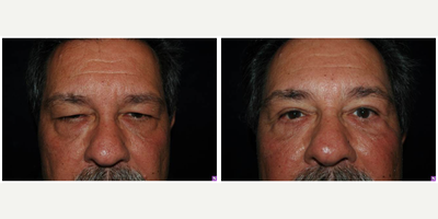 Eyelid Surgery before and after photo