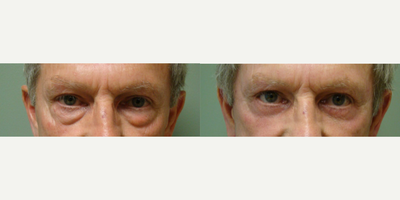 Eyelid Surgery before and after photo