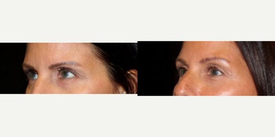 Eyelid Surgery before and after photo