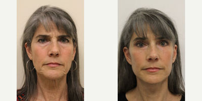 Facelift before and after photo
