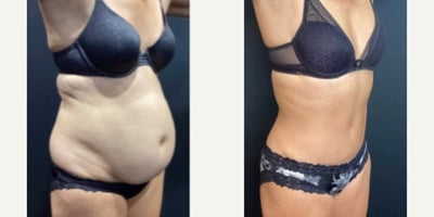 Liposuction before and after photo