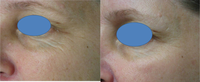 TCA Peel before and after photo