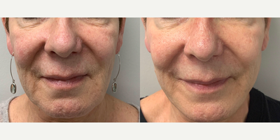 Voluma before and after photo