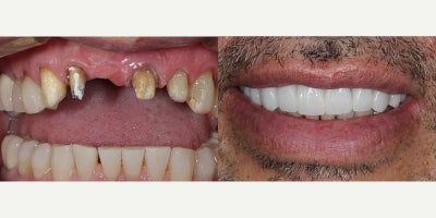 Dental Crown before and after photo