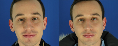 Restylane Lyft before and after photo