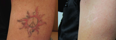 Tattoo Removal before and after photo