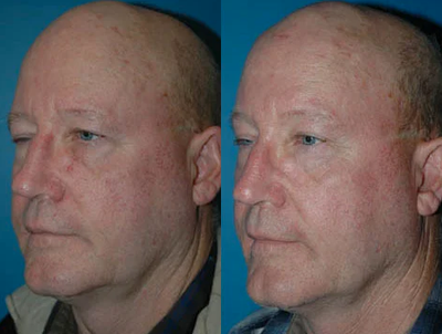 Brow Lift before and after photo