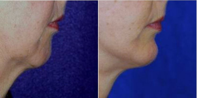 Chin Implant before and after photo