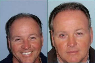 Hair Transplant before and after photo