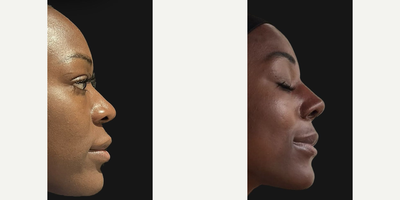 Rhinoplasty before and after photo