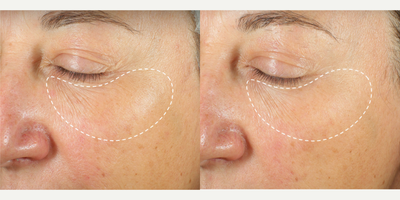 Skin Rejuvenation before and after photo