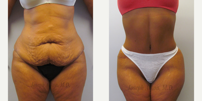 Tummy Tuck Revision before and after photo