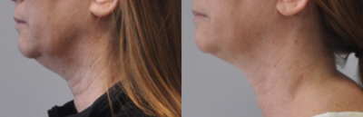 CoolSculpting before and after photo