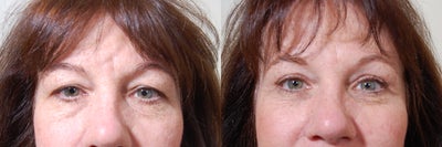 Eyelid Surgery before and after photo