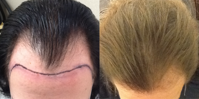 Hair Loss Treatment before and after photo