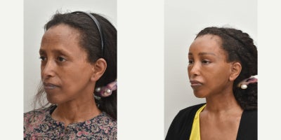 Lower Facelift before and after photo