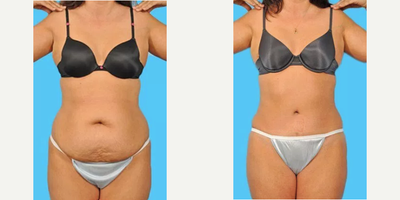 Tummy Tuck before and after photo