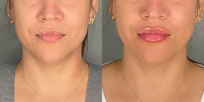 Juvederm before and after photo