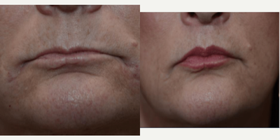 Lip Lift before and after photo