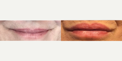 ThermiSmooth Face before and after photo