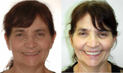 All-on-4 Dental Implants before and after photo