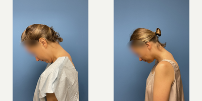 Chin Liposuction before and after photo