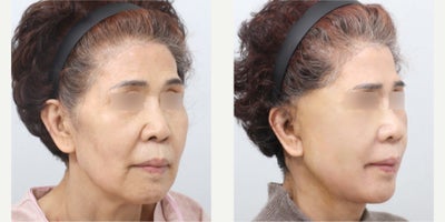 before and after image