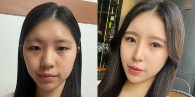 Facelift before and after photo