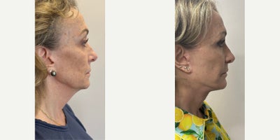 Neck Lift before and after photo
