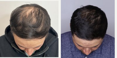 PRP for Hair Loss before and after photo